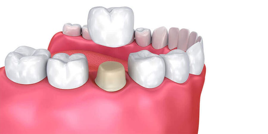 Dental Crowns Mississauga