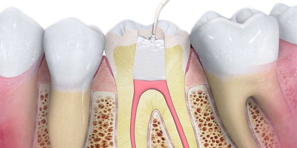 Root Canal Treatment Mississauga